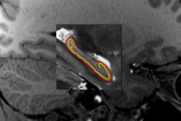 New Open-Source App for Precise Brain Mapping - Neuroscience News