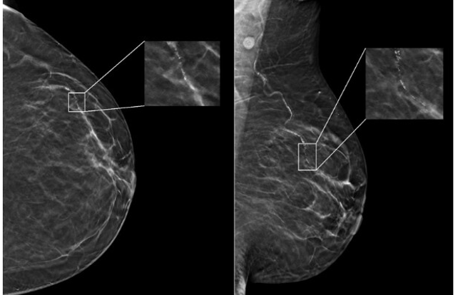 New Study Finds Age and Race Impact Artificial Intelligence (AI) Performance on Digital Mammograms