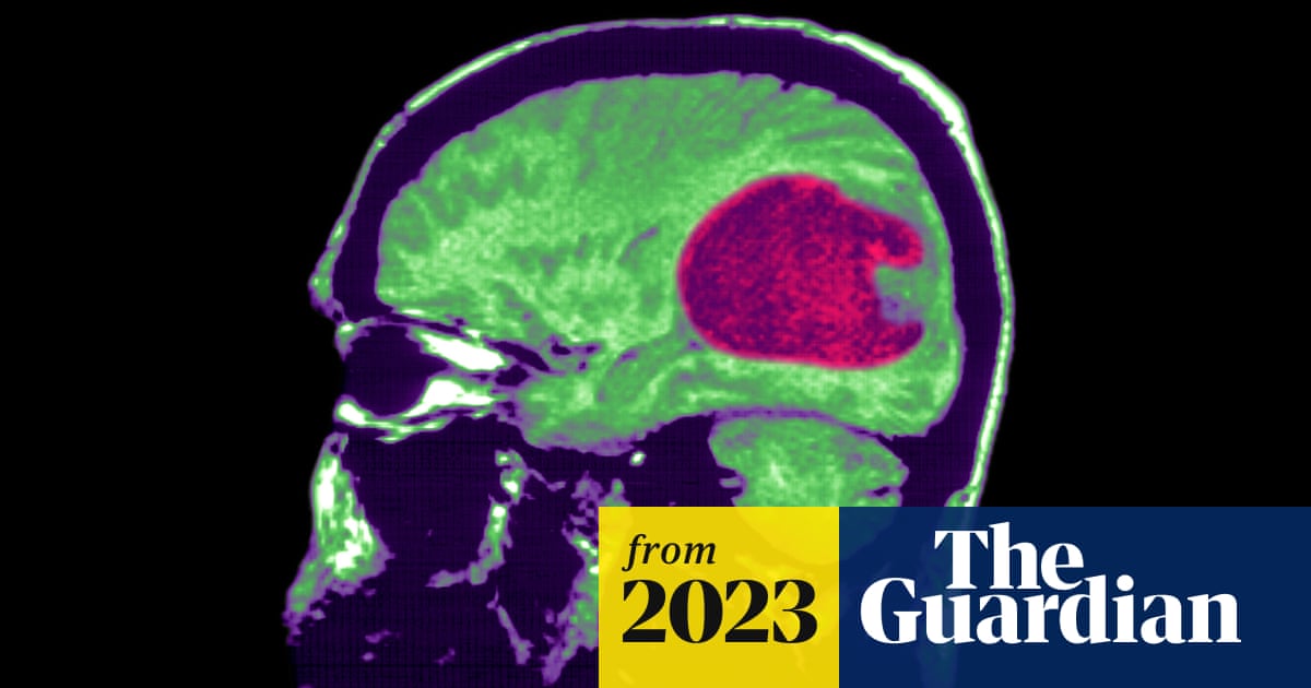 New AI tool can help treat brain tumors more quickly and accurately, study finds