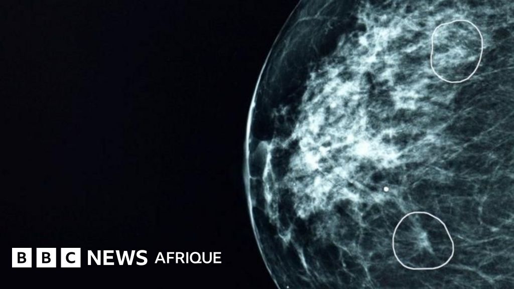 Artificial Intelligence: The Tool That Detects Cancerous Tumors Doctors Can't See - BBC News Africa