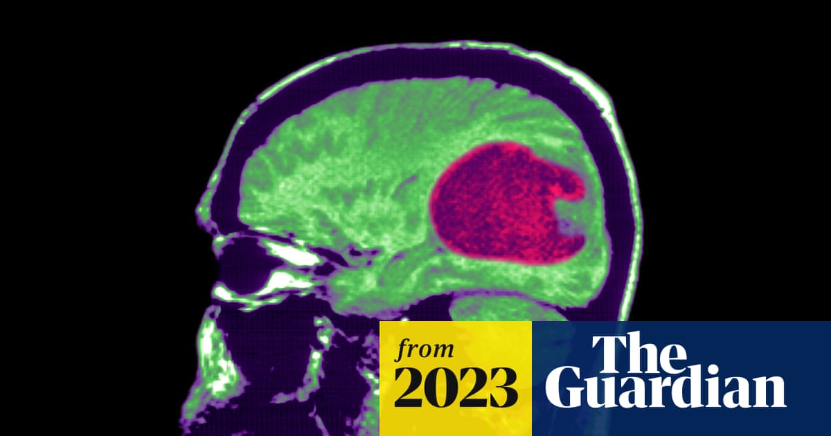 Study finds that a new AI tool can help treat brain tumors more quickly and accurately